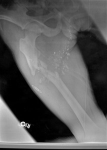 Subtrochanteric Femur Fracture Image 1