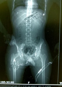 Subtrochanteric Femur Fracture Image 3