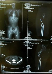 Subtrochanteric Femur Fracture Image 4