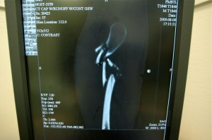 Subtrochanteric Femur Fracture Image 5