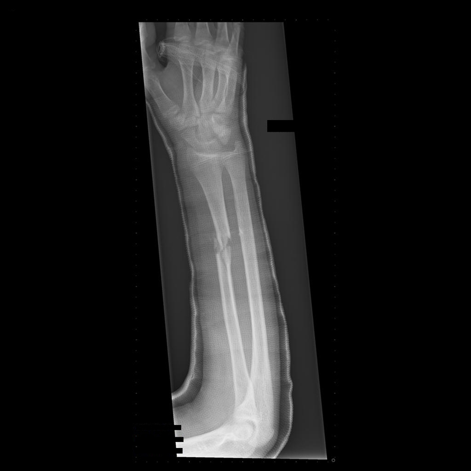 Open Forearm Fracture – Part 2 – Disaster-RX